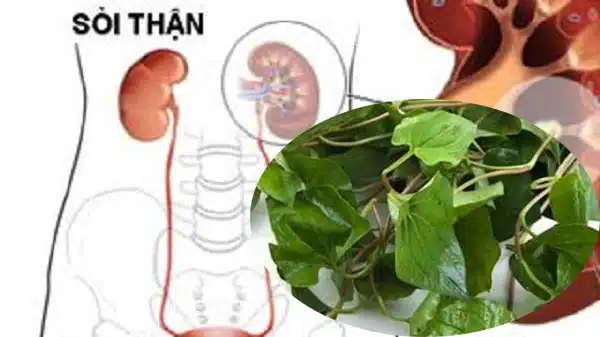 thực phẩm ngừa sỏi thận